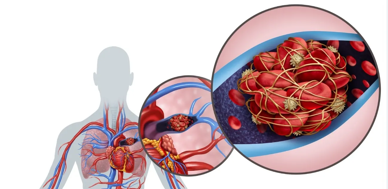 Causes of development, manifestations and treatment of pulmonary embolism