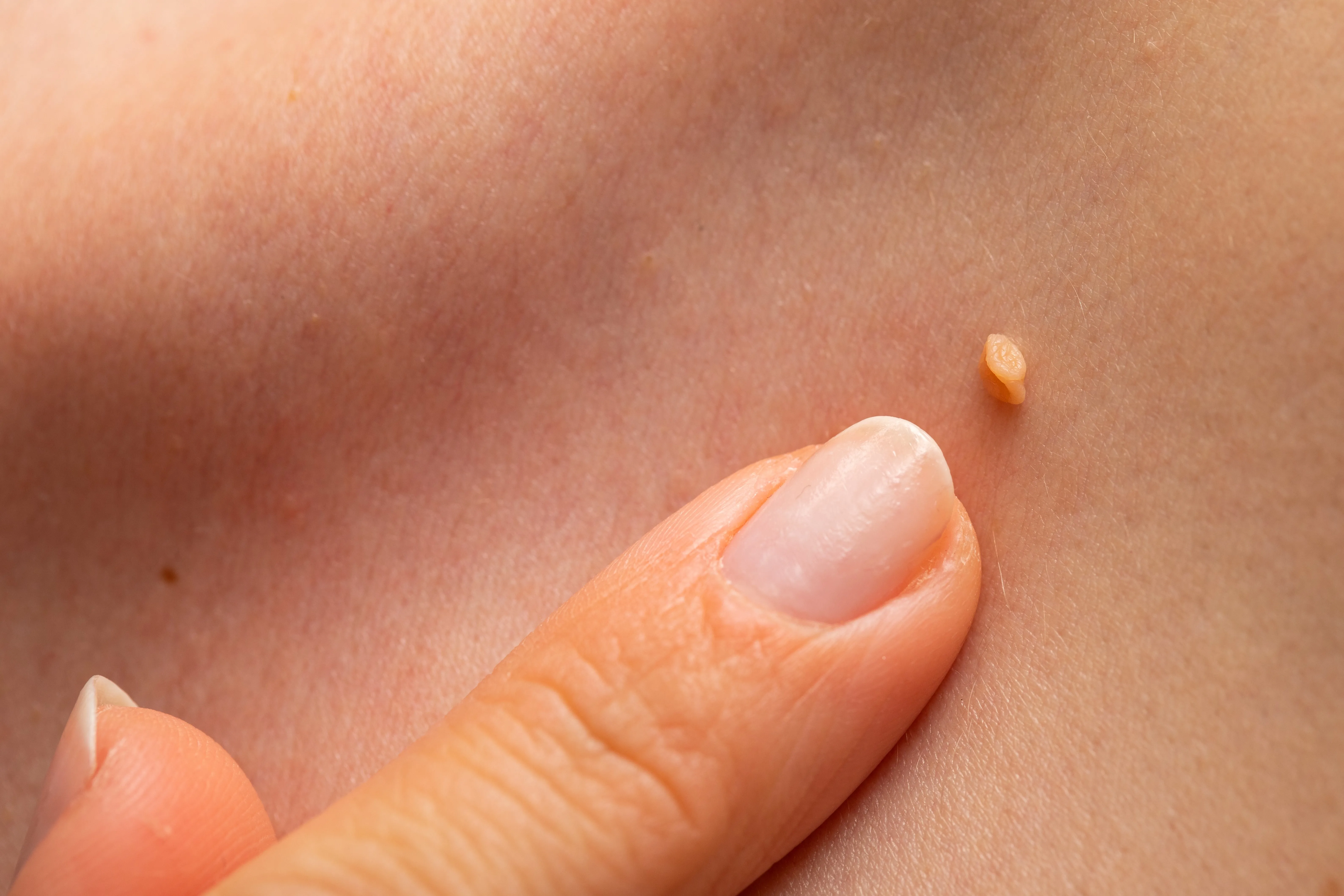 Removal of papillomas using the electrocoagulation technique: advantages and disadvantages