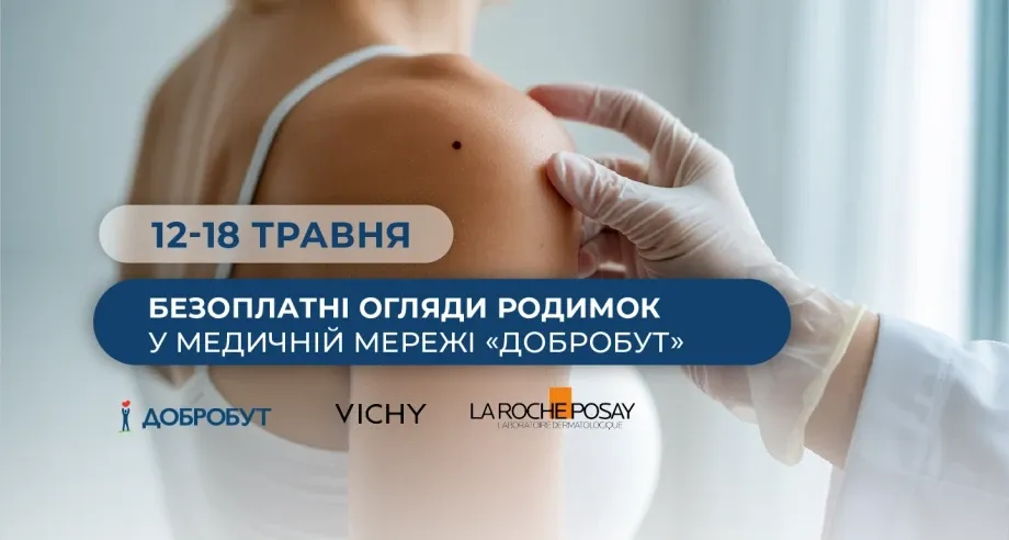 «Добробут» проведе безоплатний огляд родимок до Дня меланоми