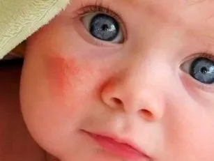 Atopic dermatitis in infants and children