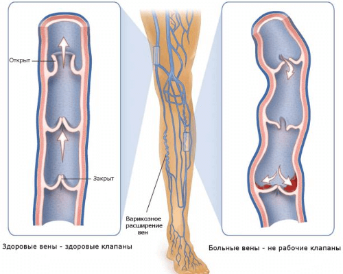 Варикоз на лице фото